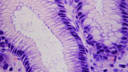 Ein adaptierter Wirkstoff könnte als Prophylaxe gegen Magenkrebs wirken